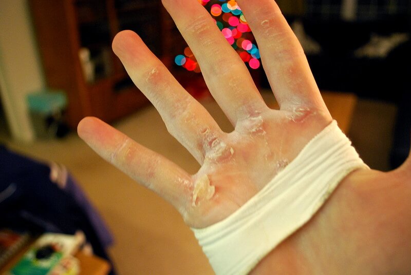 hand blisters because of rowing handles