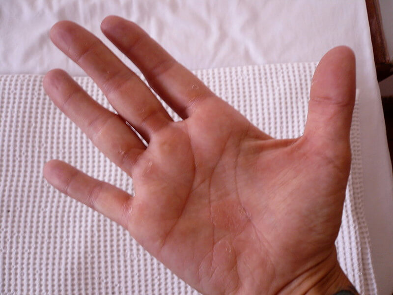hand calluses